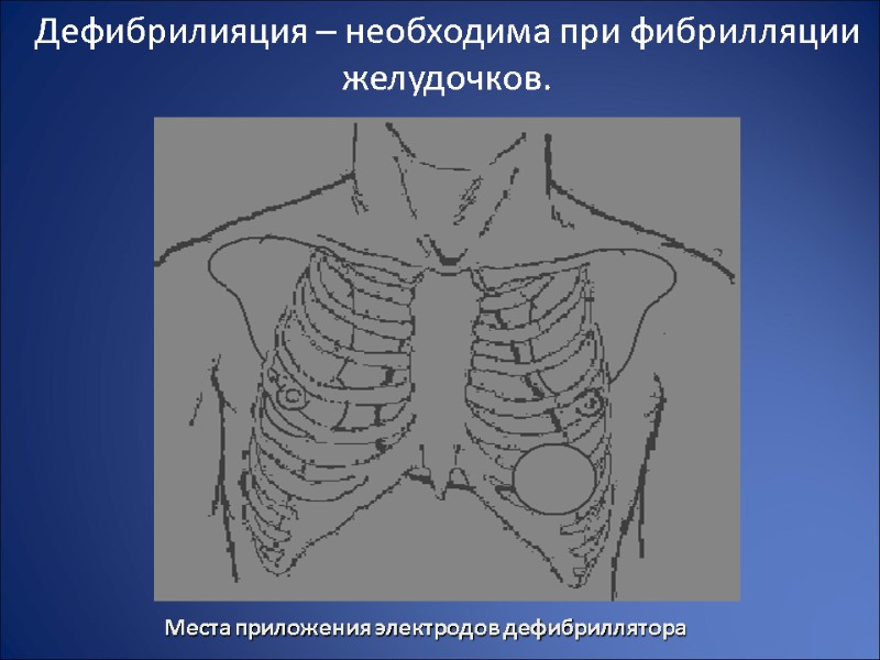 Дефибрилияция – необходима при фибрилляции желудочков.  Места приложения электродов дефибриллятора